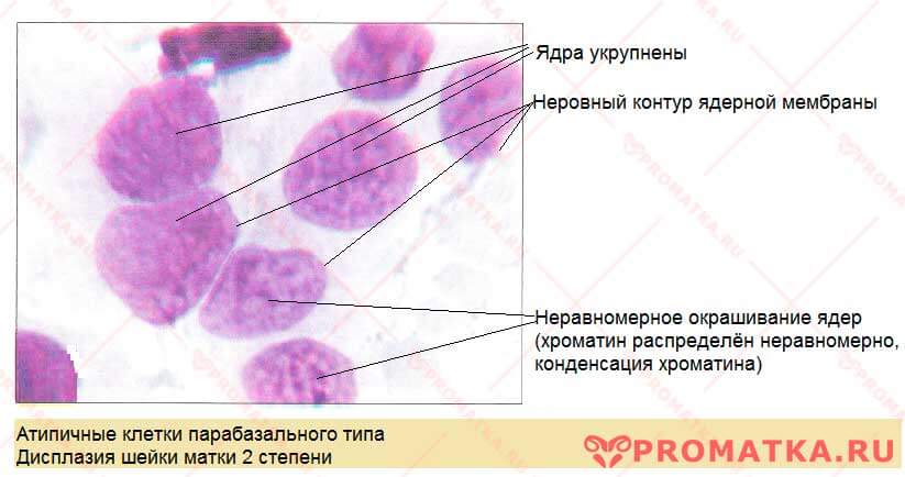 Цитология. Дисплазия 2 степени