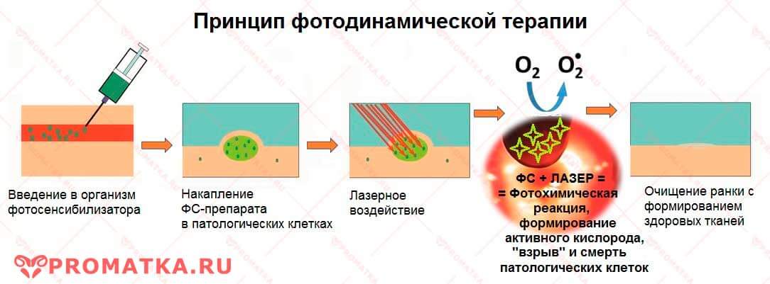 Фотодинамическая терапия дисплазии 