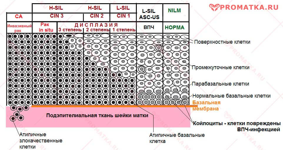 Степень дисплазии ШМ