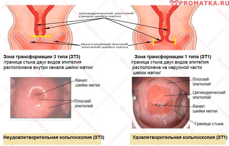 Зона трансформации ШМ