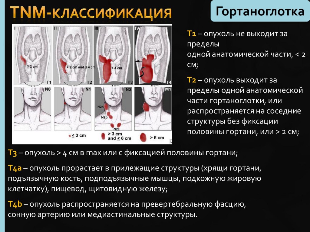 Рак гортани симптомы фото первые признаки