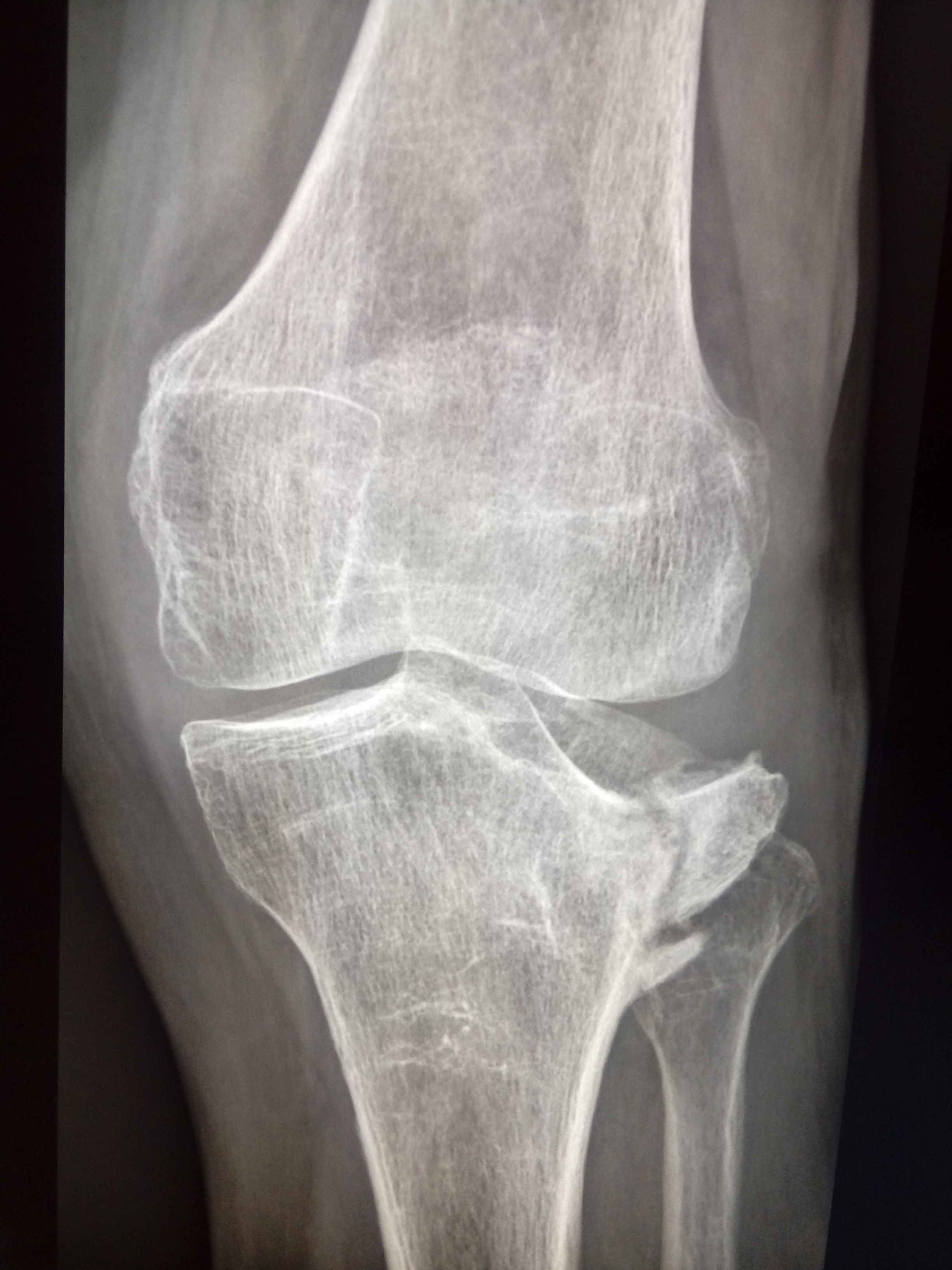 Трещина в коленной. Перелом надколенного сустава. Перелом коленного сустава рентген.