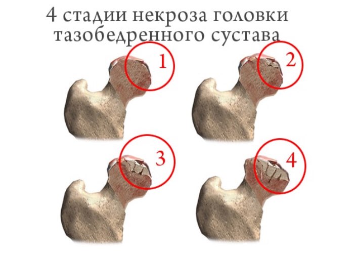 Стадии некроза головки тазобедренного сустава