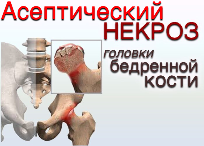 Асептический некроз головки бедренной кости