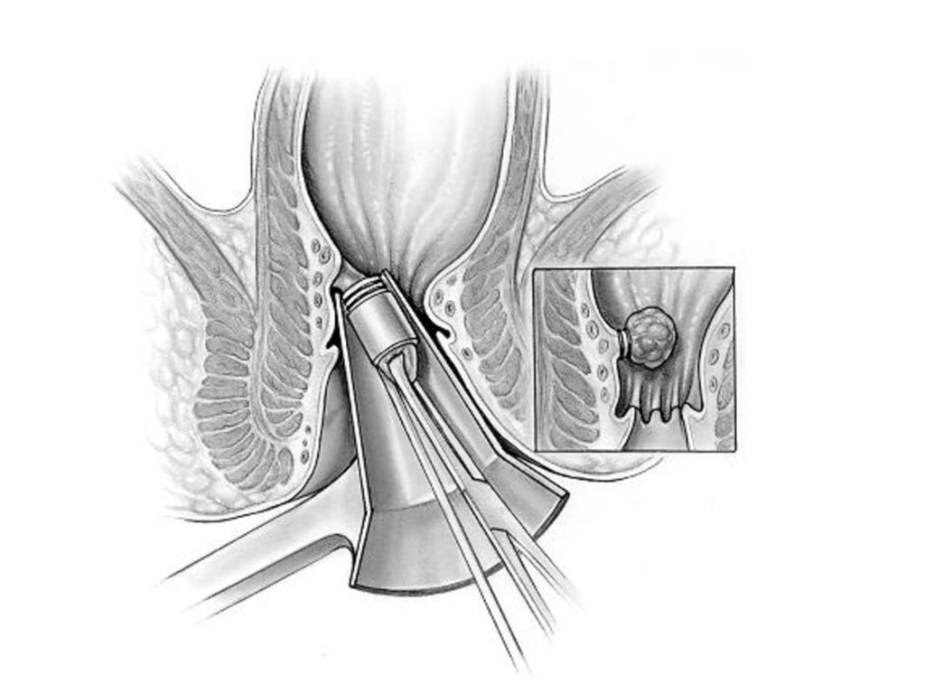 Что такое геморрой фото у женщин