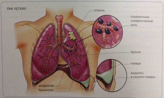 Кашель с болью в грудной клетке причины и лечение