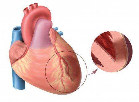 obshirnyj-infarkt-miokarda