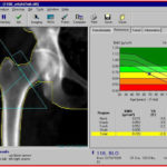 Костная денситометрия