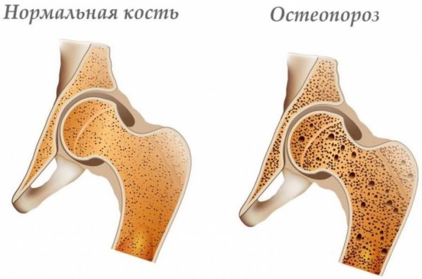 Пример больной кости при остеопорозе