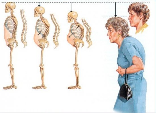 Последствия остеопороза
