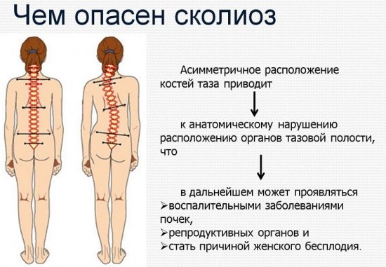 Последствия сколиоза
