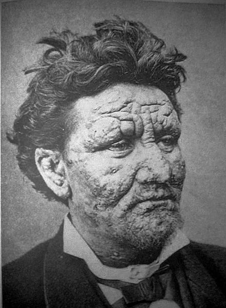 Лицо 24-летнего больного лепрой. 1886 год