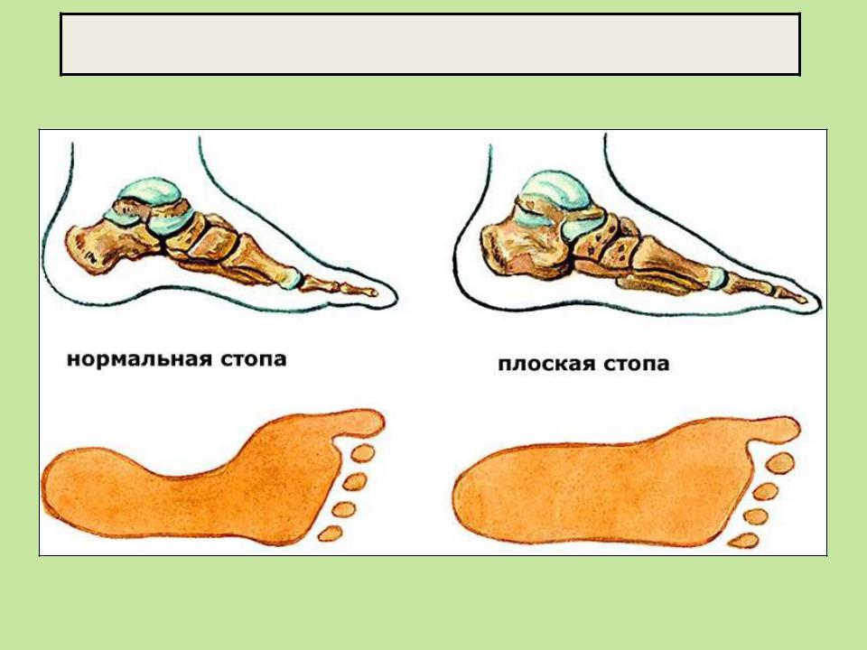 Плоскостопие у взрослого симптомы симптомы, причины, диагностика, лечение и профилактика