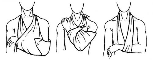 Косыночная повязка на плечо