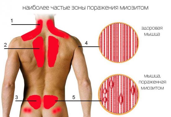 Зоны наибольшего поражения миозитом