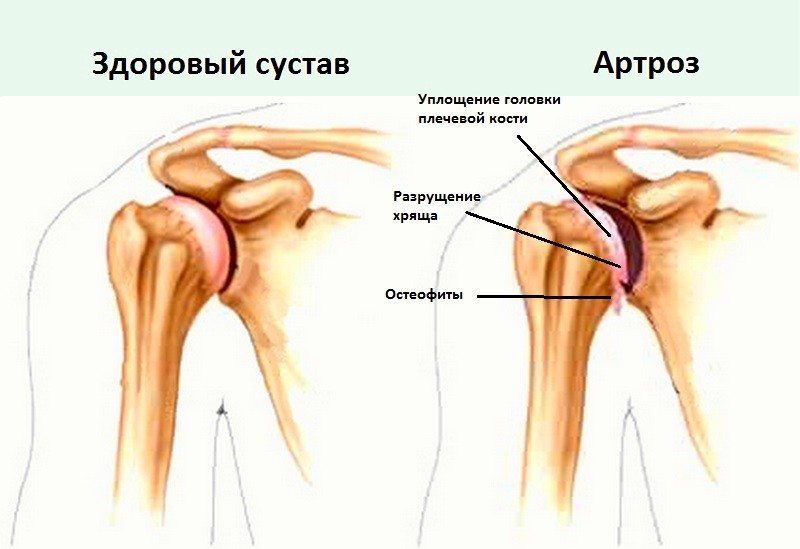 Артроз плечевого сустава