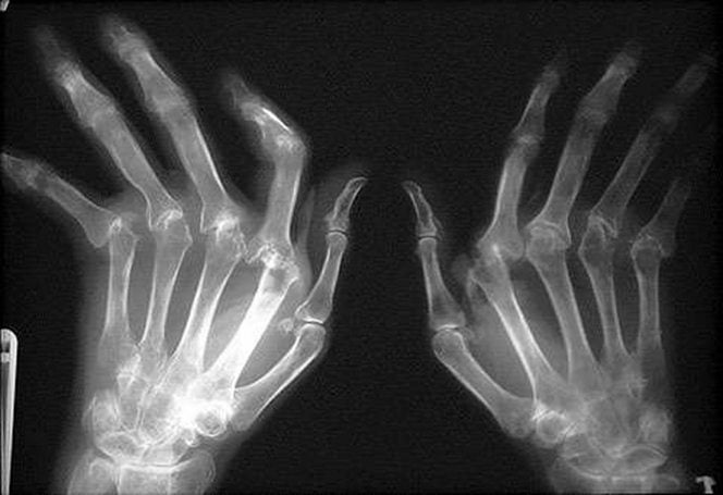 Рентген при ревматоидном артрите 