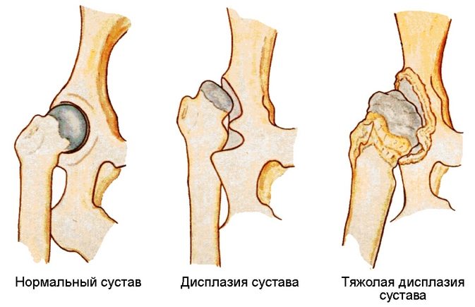 Дисплазия