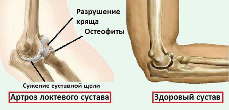 Артроз локтевого сустава