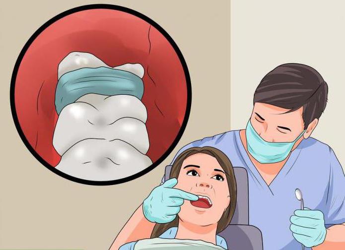alveolitis after tooth extraction treatment at home