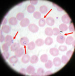 Malaria parasites in blood smear.jpg