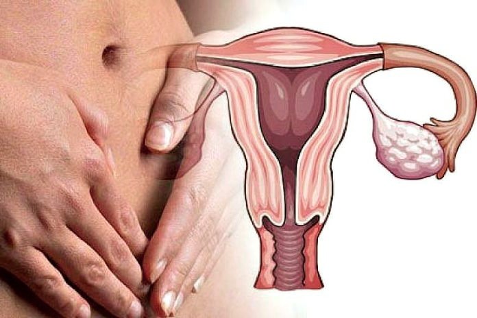 Воспалительные болезни женских половых органов