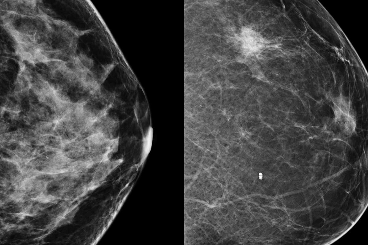 Фиброзные жировые изменения. Доброкачественная дисплазия молочных желёз. Фиброзно-кистозная мастопатия маммография. Фиброзная мастопатия маммограмма. Кистозная мастопатия маммография.