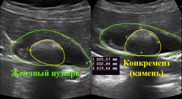 Выявление камней в желчном пузыре