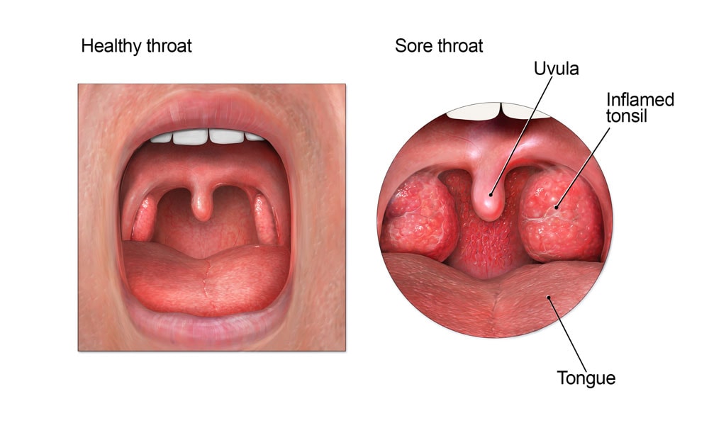 Anatomy of the mouth, showing inflamed tonsils in a sore throat.