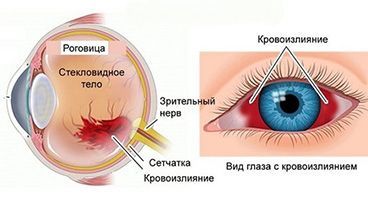 ΠΡΠΎΠ²ΠΎΠΈΠ·Π»ΠΈΡΠ½ΠΈΠ΅ Π² Π³Π»Π°Π·