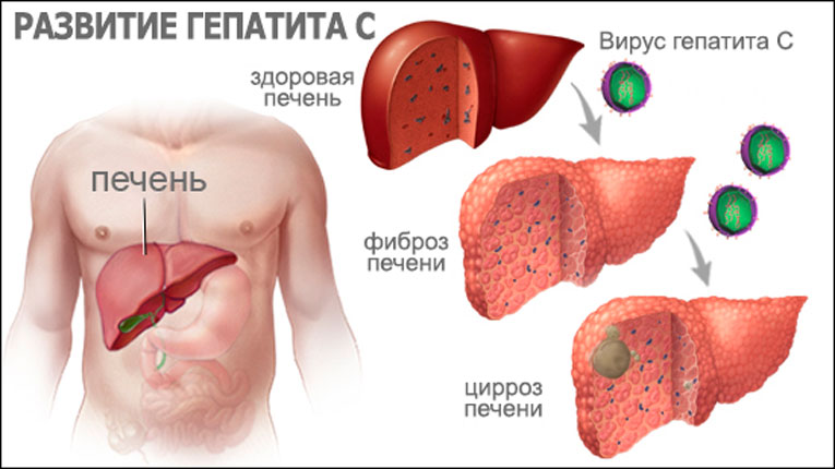 Развитие хронического гепатита С Развитие хронического гепатита С