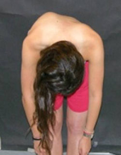 Photo of a patient doing Adams forward-bending test, revealing pronounced curvature of the spine.