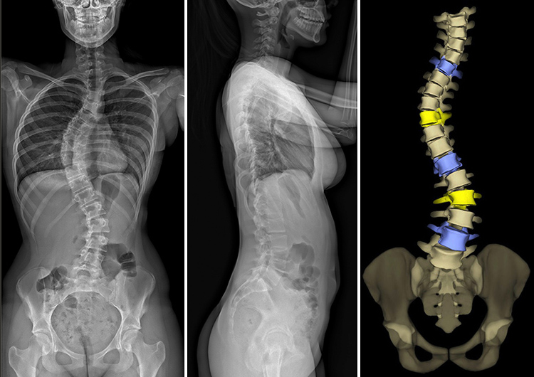 eos low-dose radiation imaging of scoliosis