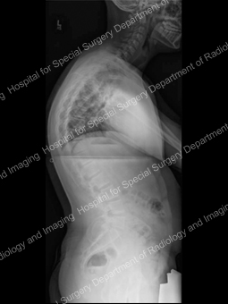X-ray image showing side view of patient with kyphosis in the thoracic spine.
