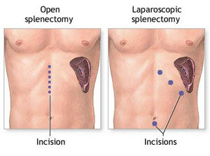 Splenectomy image
