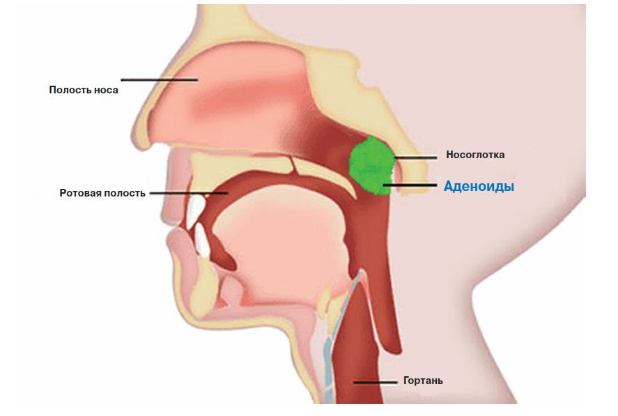 аденоиды