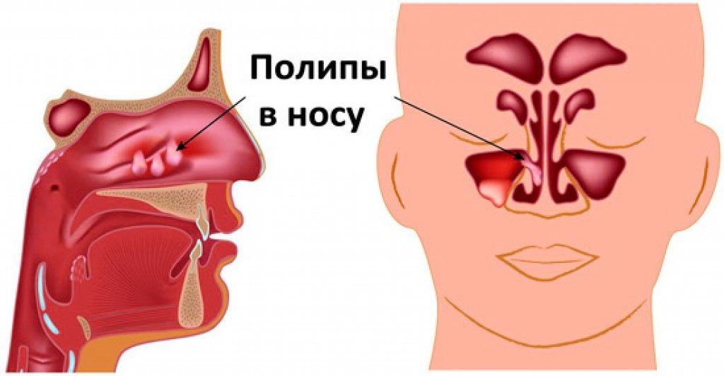 полипы2