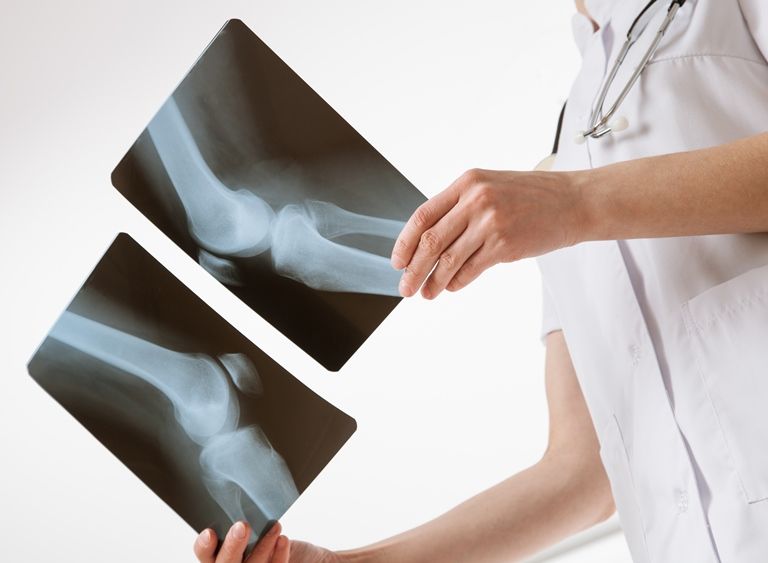 Для выяснения причин ломоты в суставах может назначаться рентгенография
