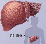 Цирроз печени Цирроз печени