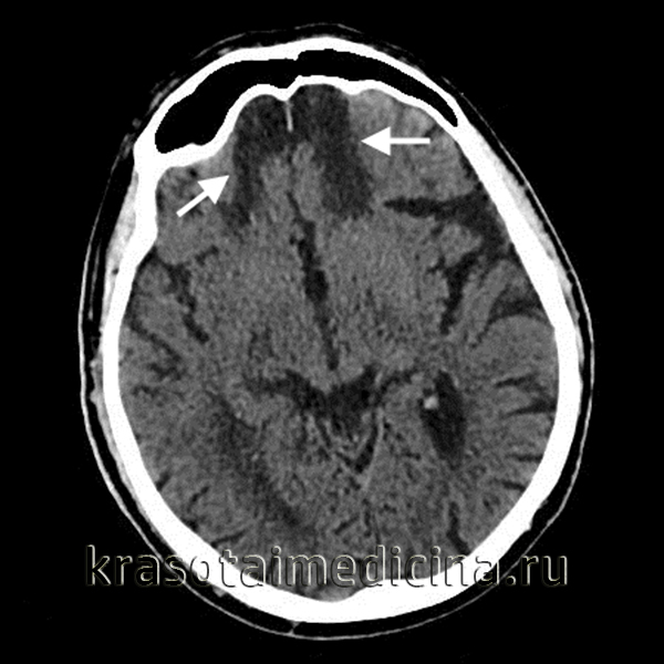 КТ головного мозга. Определяются кисты посттравматического характера в передних отделах обеих лобных долей
