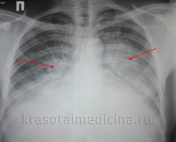 Рентгенограмма ОГК. Выраженный отек легких у пациента с терминальной почечной недостаточностью.