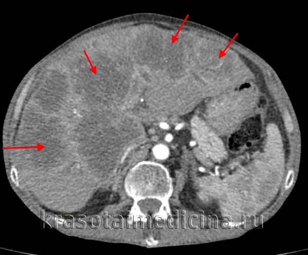 КТ ОБП С+. Множественные гиподенсные/гиповаскулярные вторичные очаги в печени с тонким гиперваскулярным ободком по периферии у пациента с первичной опухолью толстой кишки.