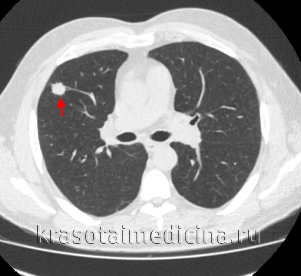 КТ органов грудной клетки. Солидное объемное образование (злокачественная периферическая опухоль) с лучистыми краями в верхней доле правого легкого
