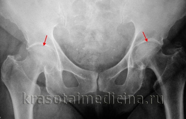 Рентгенография тазобедренных суставов. Двухсторонний коксартроз: сужение суставной щели, склероз суставных поверхностей.