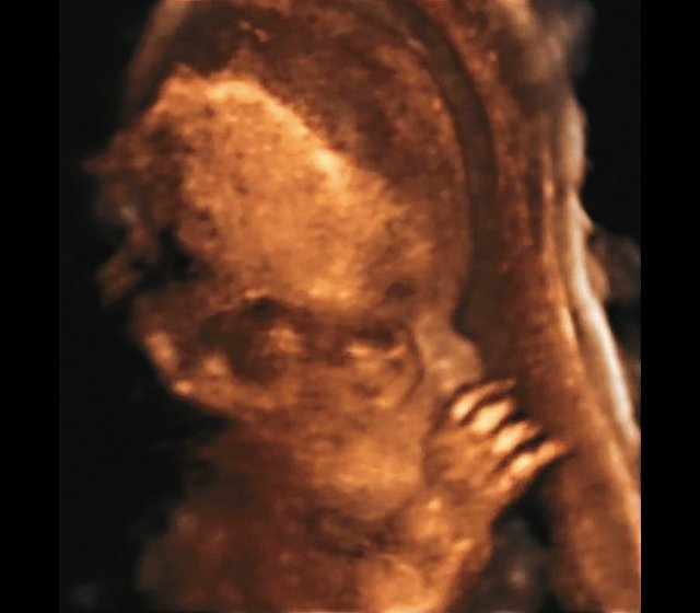 УЗИ плода (3D) - видны высокий выпуклый лоб, расширенный передний родничок и сагиттальный шов, правильная установка пальцев (беременность 26,5 нед)