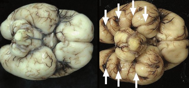 Картина мозга при аутопсии - отражена нижняя поверхность височных долей мозга в норме и с аномальной радиальной бороздчатостью височных долей плода (беременность 23 нед)