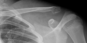 Fracture-Clavicle-Figure2_1252812-Clavicle_lateral_third.jpg