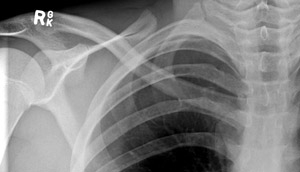 Fracture-Clavicle-Figure3A_0868387-SC-joint.jpg