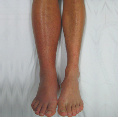 blood clot in leg swelling