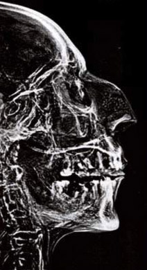 An older x-ray of the   head of Ramesses II